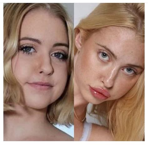 chloe cherry before after|chloe cherry lip filler.